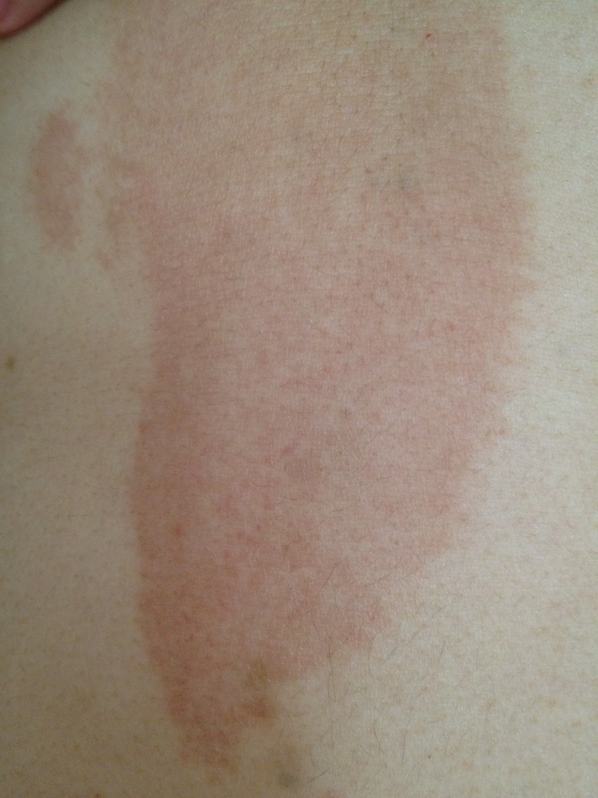 Palmer's cocoa butter. See it used on me! Do not read post if sensitive